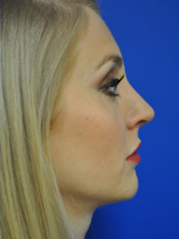Rhinoplasty Case 4444 After Photo Rhinoplasty