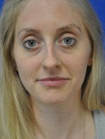 Rhinoplasty