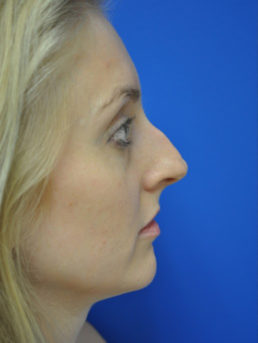 Rhinoplasty Case 4444 Before Photo Rhinoplasty