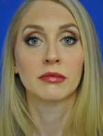 Rhinoplasty