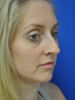 Rhinoplasty