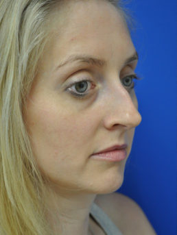 Rhinoplasty Case 4444 Before Photo Rhinoplasty