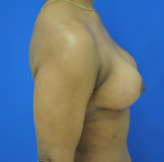 Breast Lift / Mastopexy