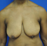 Breast Lift / Mastopexy