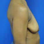 Breast Lift / Mastopexy
