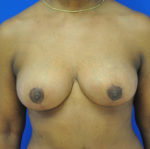 Breast Lift / Mastopexy