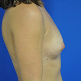 Breast Augmentation Case 4507 Before Photo Breast Augmentation