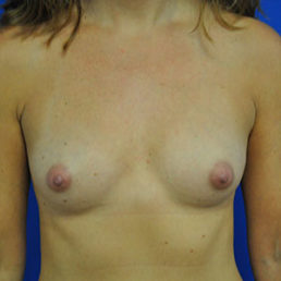 Breast Augmentation Case 4507 Before Photo Breast Augmentation
