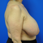 Breast Procedures