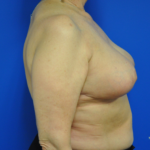 Breast Procedures