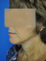 Facelift