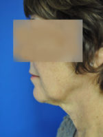 Facelift