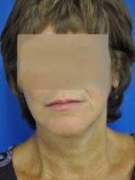 Facelift