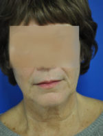 Facelift