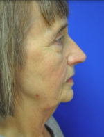Facelift