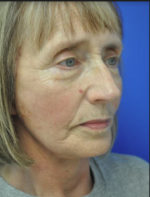 Facelift