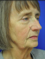 Facelift