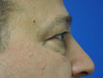 Eyelid Surgery