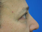 Eyelid Surgery