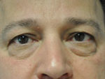 Eyelid Surgery