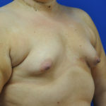 Complex Primary Breast Augmentation