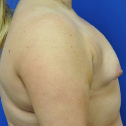 Complex Primary Breast Augmentation Case 4698 Before Photo Complex Primary Breast Augmentation