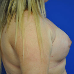 Complex Primary Breast Augmentation Case 4698 After Photo Complex Primary Breast Augmentation