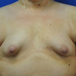 Complex Primary Breast Augmentation