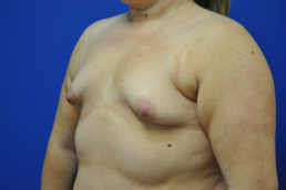 Complex Primary Breast Augmentation Case 4698 Before Photo Complex Primary Breast Augmentation