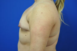 Complex Primary Breast Augmentation Case 4698 Before Photo Complex Primary Breast Augmentation
