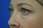 Eyelid Surgery