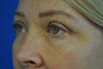 Eyelid Surgery
