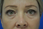Eyelid Surgery