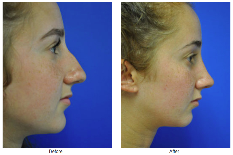 Rhinoplasty