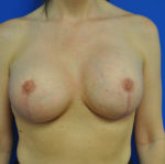 Revisional & Corrective Breast Augmentation