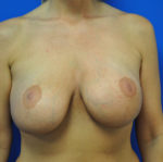 Revisional & Corrective Breast Augmentation