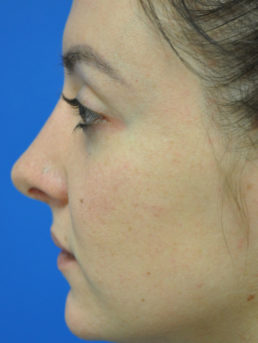 Rhinoplasty Case 4826 After Photo Rhinoplasty