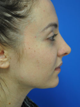 Rhinoplasty Case 4826 After Photo Rhinoplasty