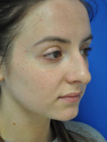 Rhinoplasty