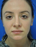 Rhinoplasty