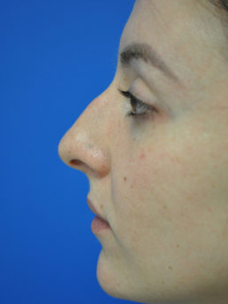 Rhinoplasty Case 4826 Before Photo Rhinoplasty