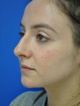 Rhinoplasty Case 4826 Before Photo Rhinoplasty
