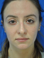 Rhinoplasty