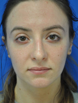Rhinoplasty Case 4826 Before Photo Rhinoplasty