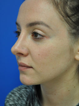 Rhinoplasty Case 4826 After Photo Rhinoplasty