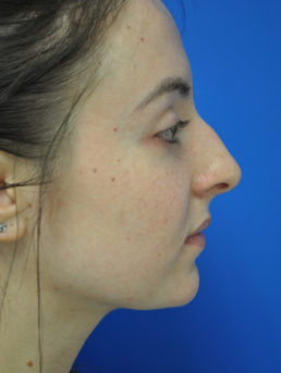 Rhinoplasty Case 4826 Before Photo Rhinoplasty