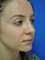 Rhinoplasty