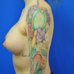 Breast Augmentation