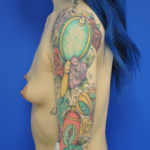 Breast Augmentation