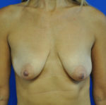 Combination Breast Lift / Augmentation